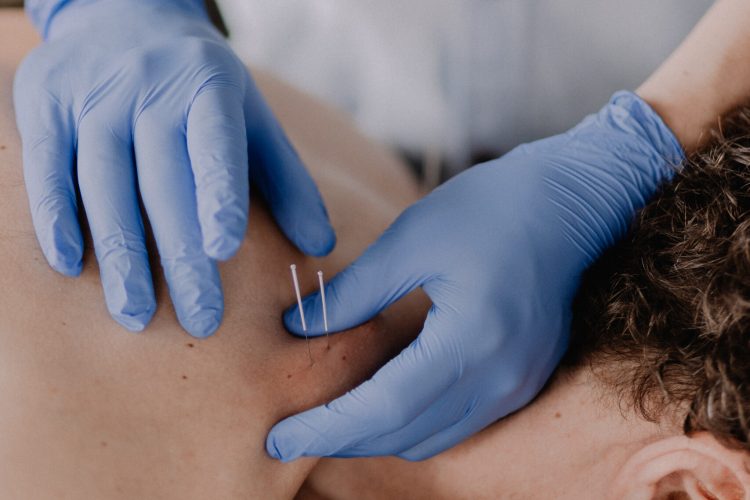 Suche igłowanie w dysfunkcjach mięśniowo-powięziowych