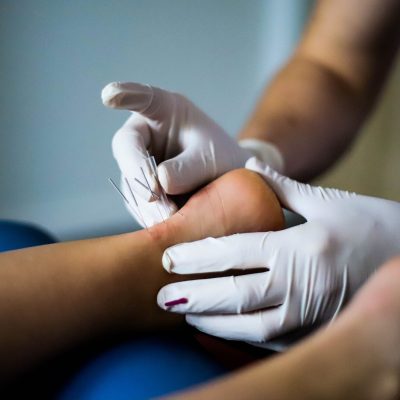 Suche igłowanie: Szkolenie „Must-have” dla każdego fizjoterapeuty!